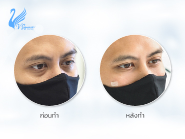 รีวิว ฟิลเลอร์ใต้ตา