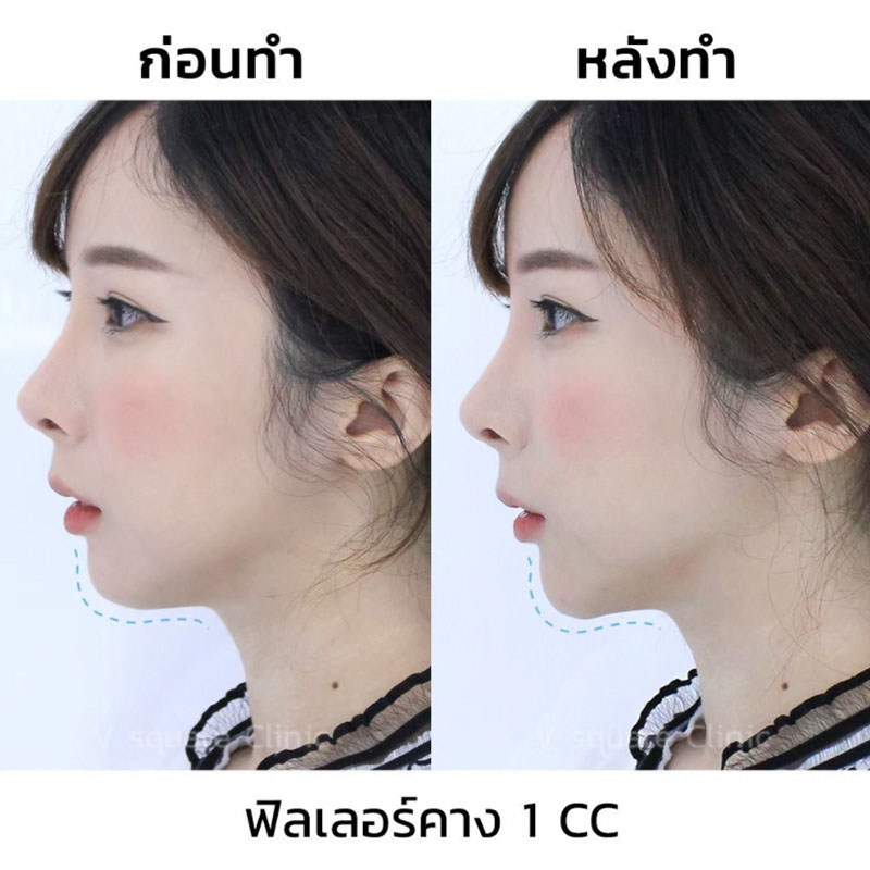 รีวิวฉีดฟิลเลอร์คาง