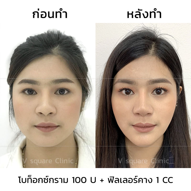 รีวิวฉีดฟิลเลอร์คาง2