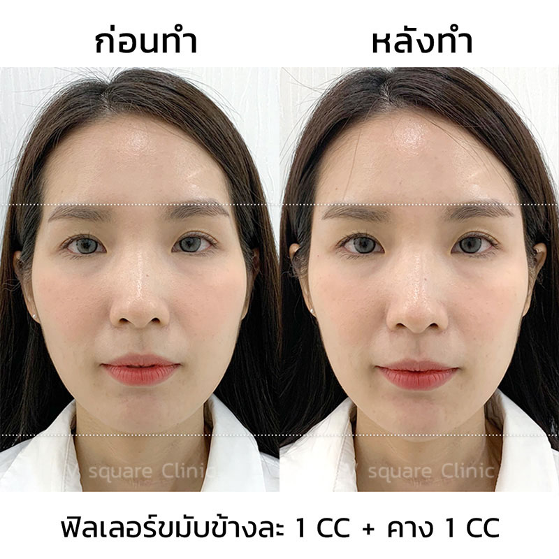 รีวิวฉีดฟิลเลอร์คาง3