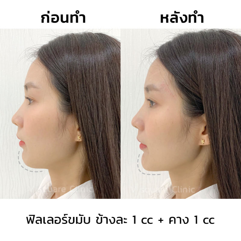รีวิวฉีดฟิลเลอร์คาง3