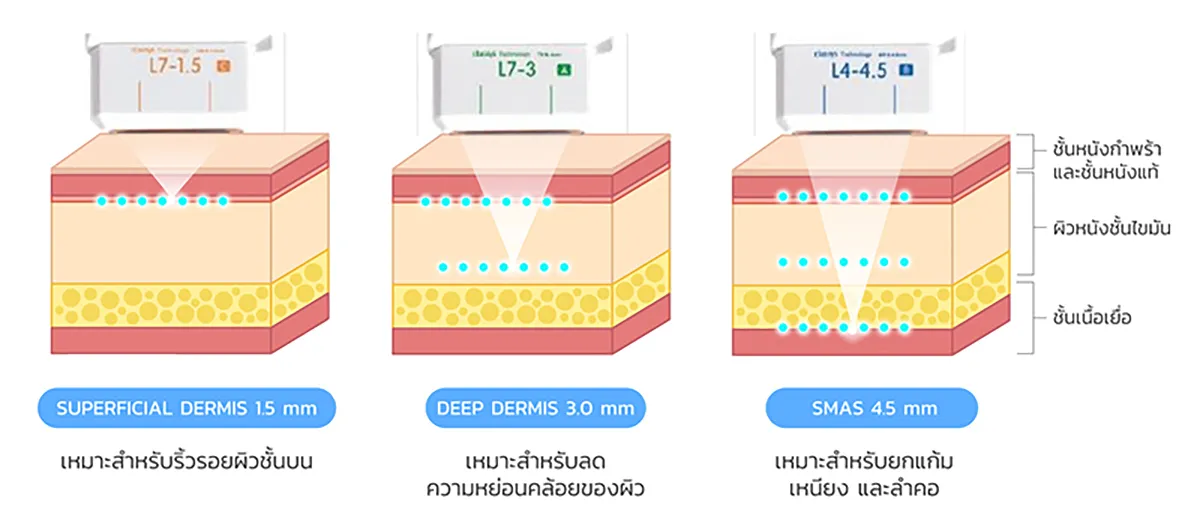 Hifu tips