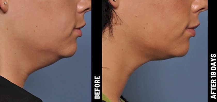 รีวิวทำ Ulthera ใต้คาง เหนียง