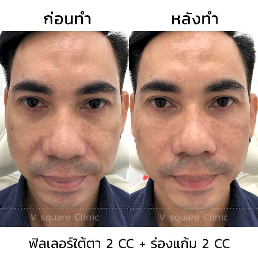 รีวิวฟิลเลอร์ร่องแก้ม