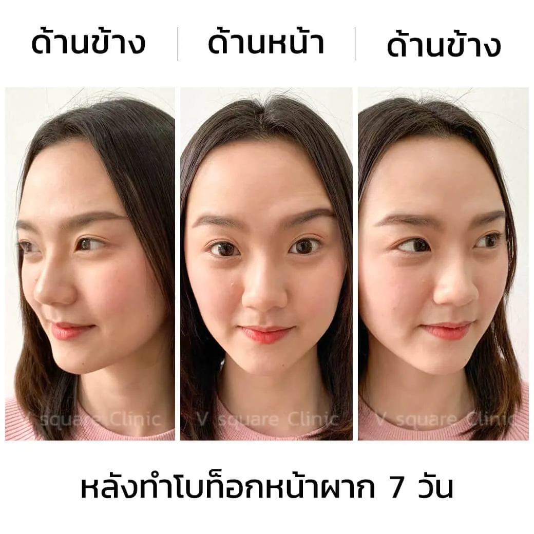 ฉีดโบท็อกหน้าผาก ลดริ้วรอย กี่วันเห็นผล ? อยู่ได้นานไหม ? ใช้กี่ยูนิต ?