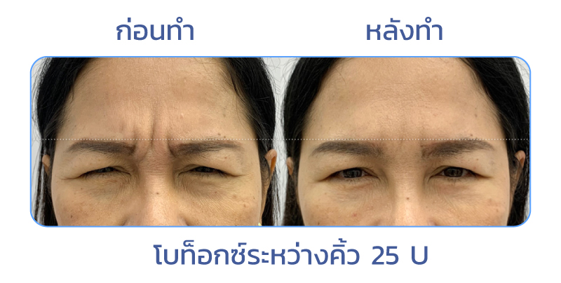 ฉีดโบท็อกระหว่างคิ้ว รีวิว