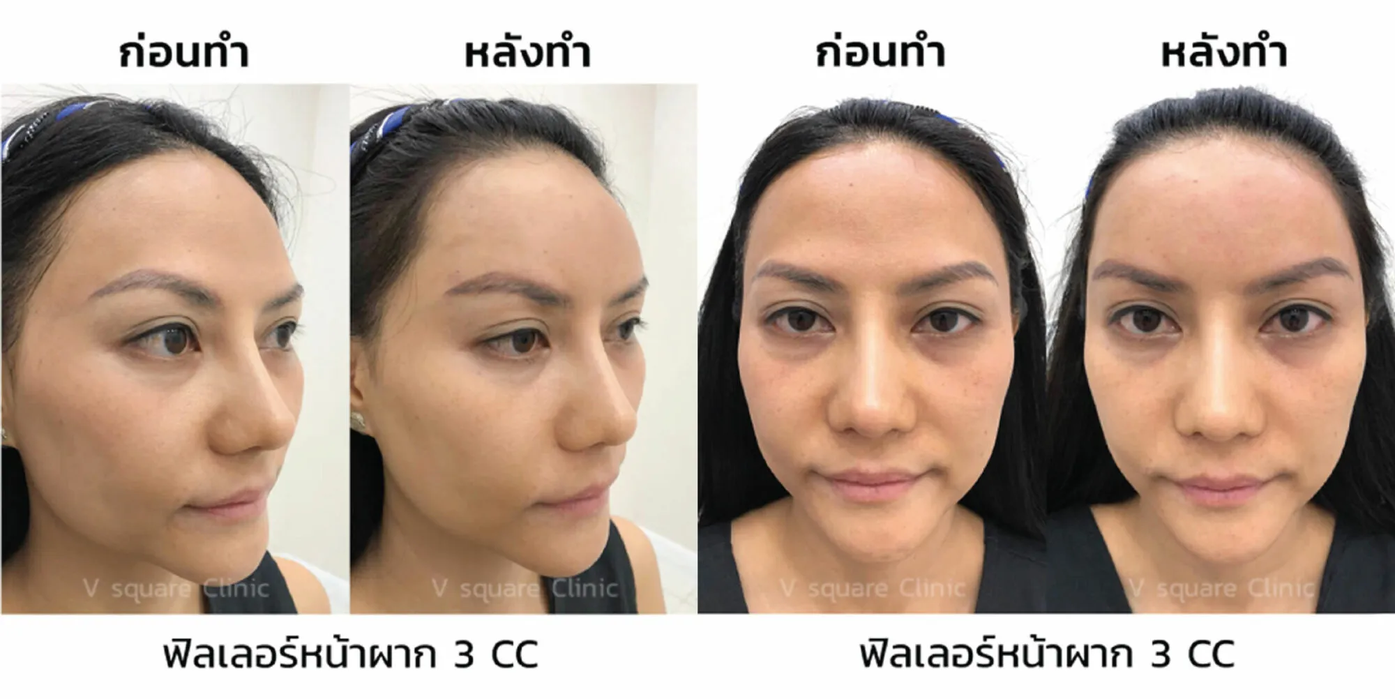 รีวิวฉีดฟิลเลอร์หน้าผาก 3 cc