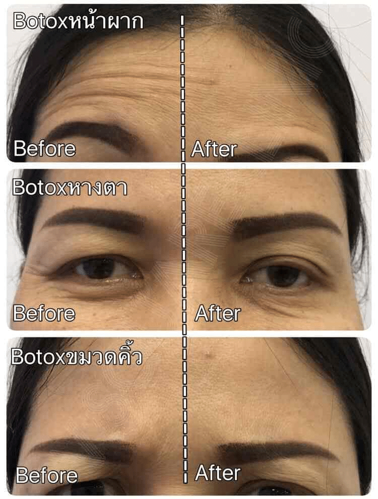 รีวิวฉีดโบท็อกระหว่างคิ้ว