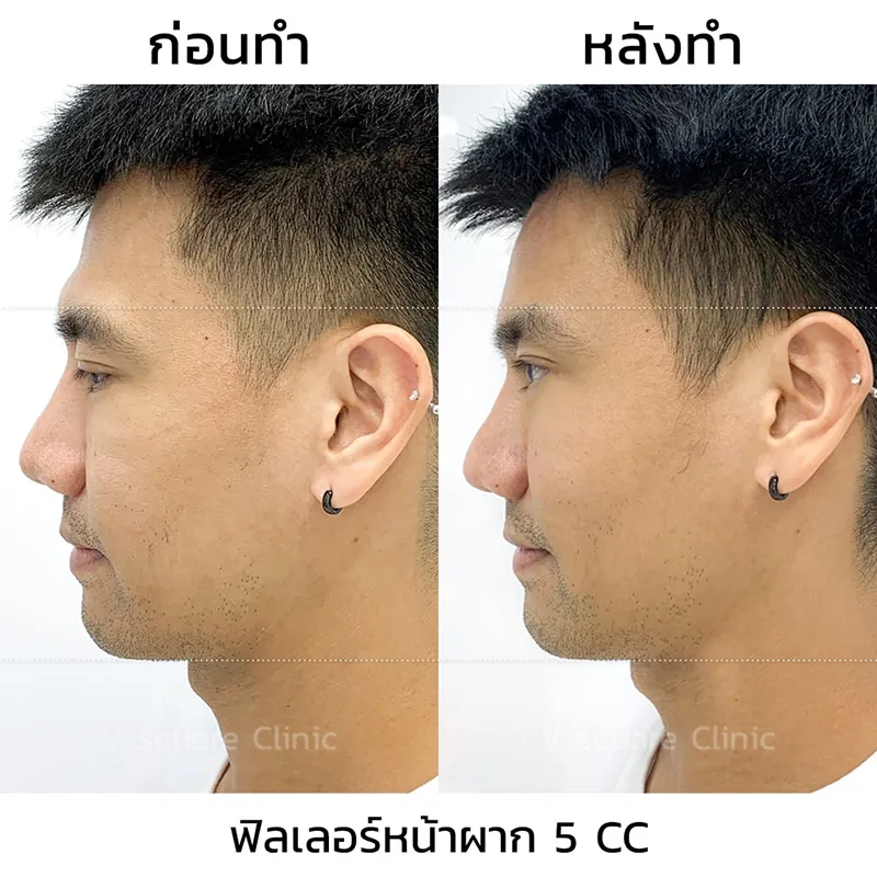 รีวิวฟิลเลอร์หน้าผาก(1) พีท