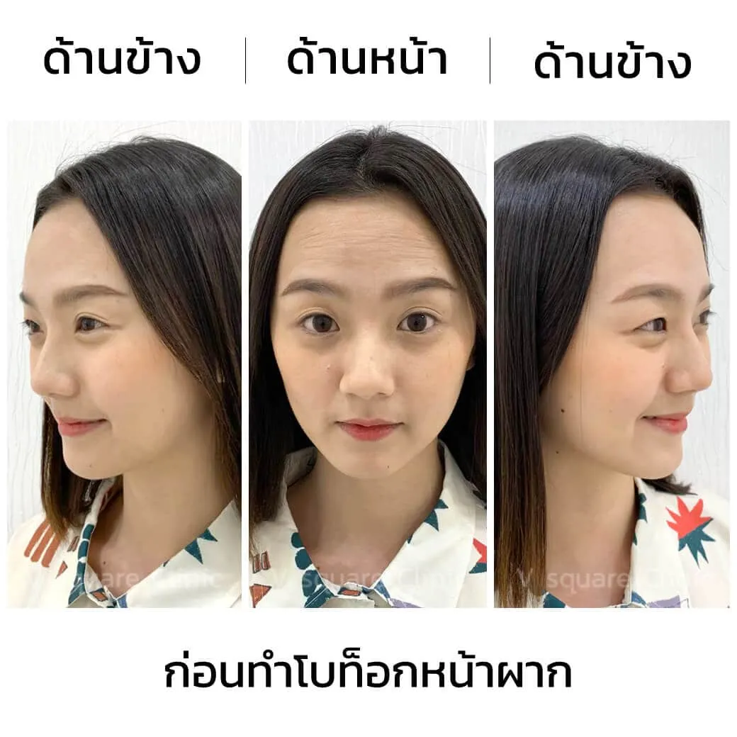 รีวิวโบท็อกหน้าผาก