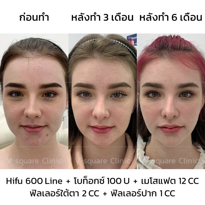 ฉีดแฟตรีวิว คุณเจสซี่