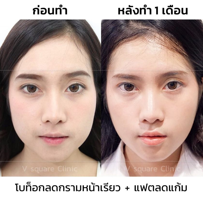 เมโสแฟตรีวิว