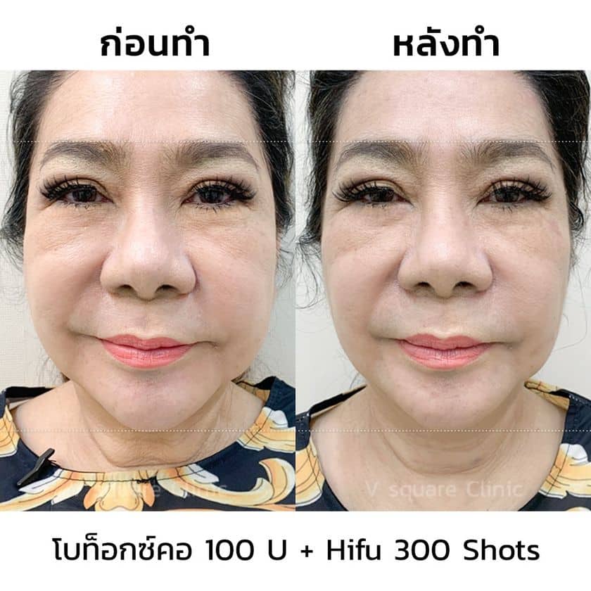 โบท็อกลิฟหน้ารีวิว