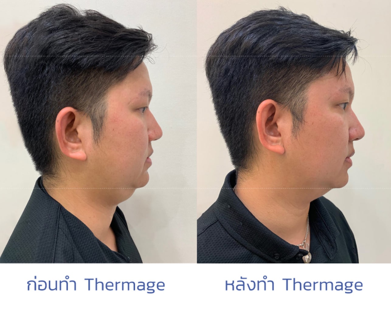 Thermage รีวิว