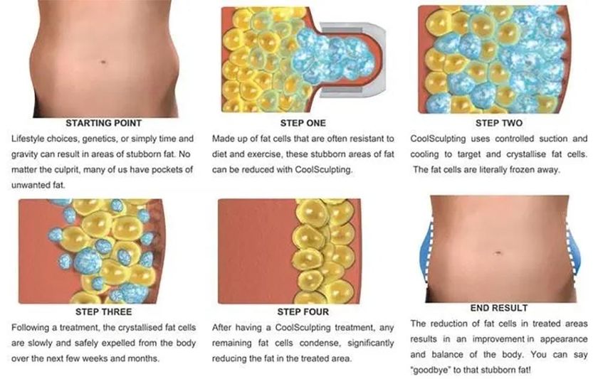 การทำงานของเครื่อง Coolsculpting สลายไขมันด้วยความเย็น