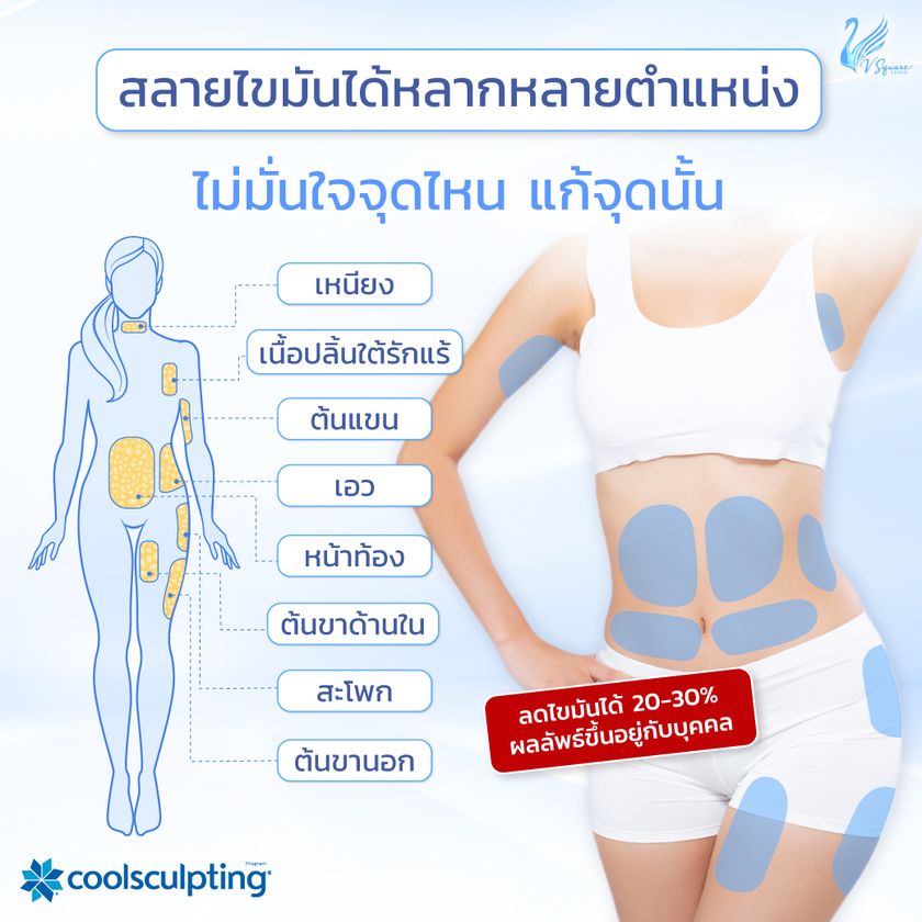 ตำแหน่งสลายไขมันด้วยความเย็น