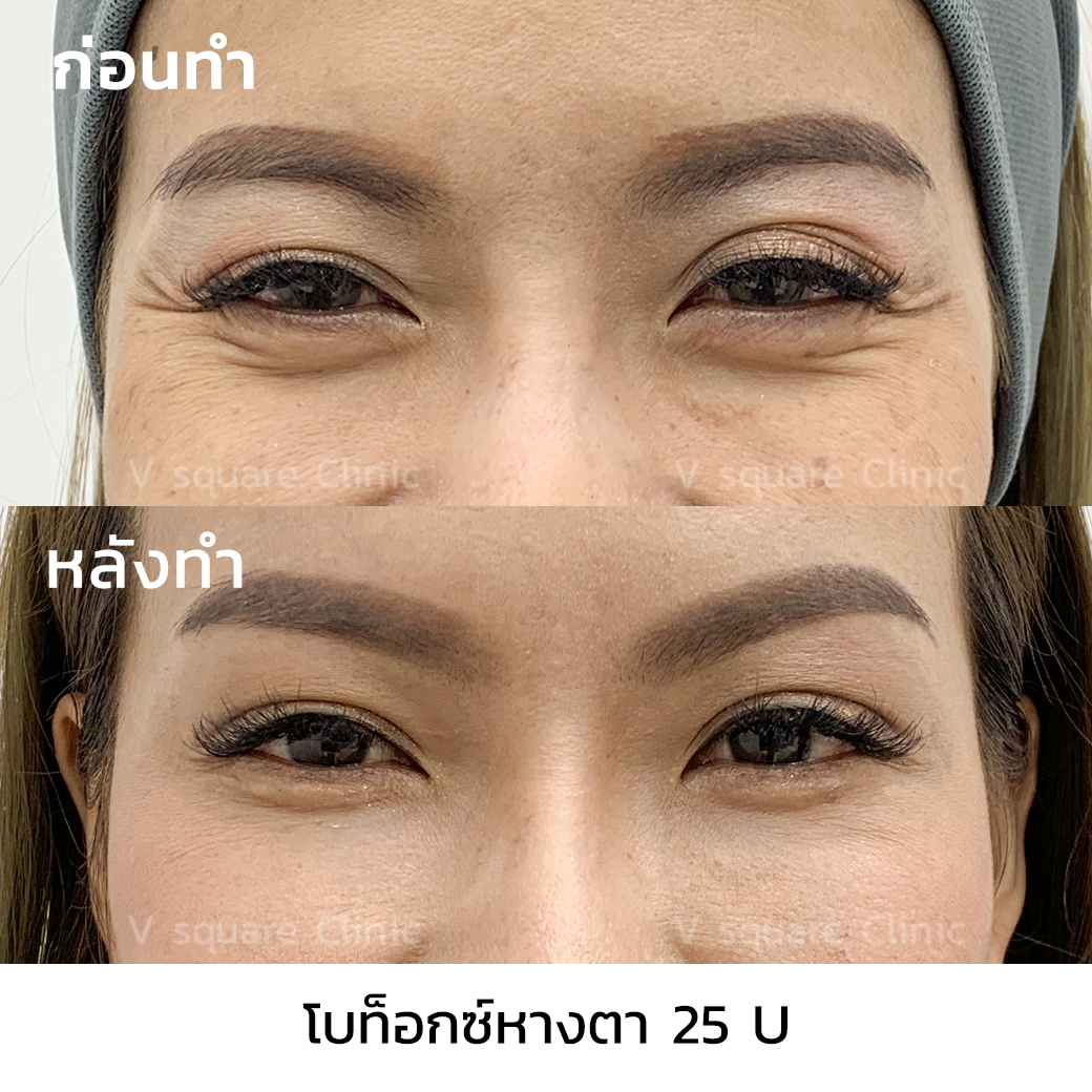 รีวิวผลลัพธ์หลังฉีดโบท็อก