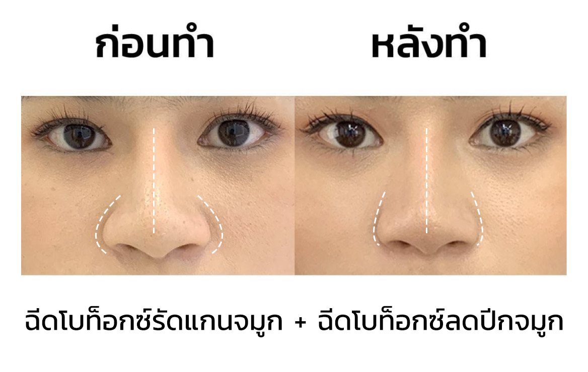 รีวิวผลลัพธ์หลังฉีดโบท็อก