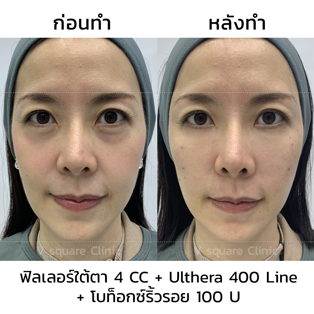 รีวิวผลลัพธ์หลังฉีดโบท็อก