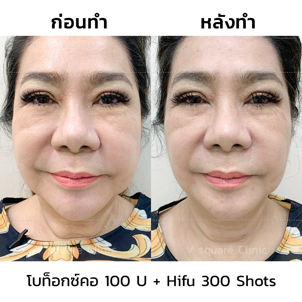 รีวิวผลลัพธ์หลังฉีดโบท็อก