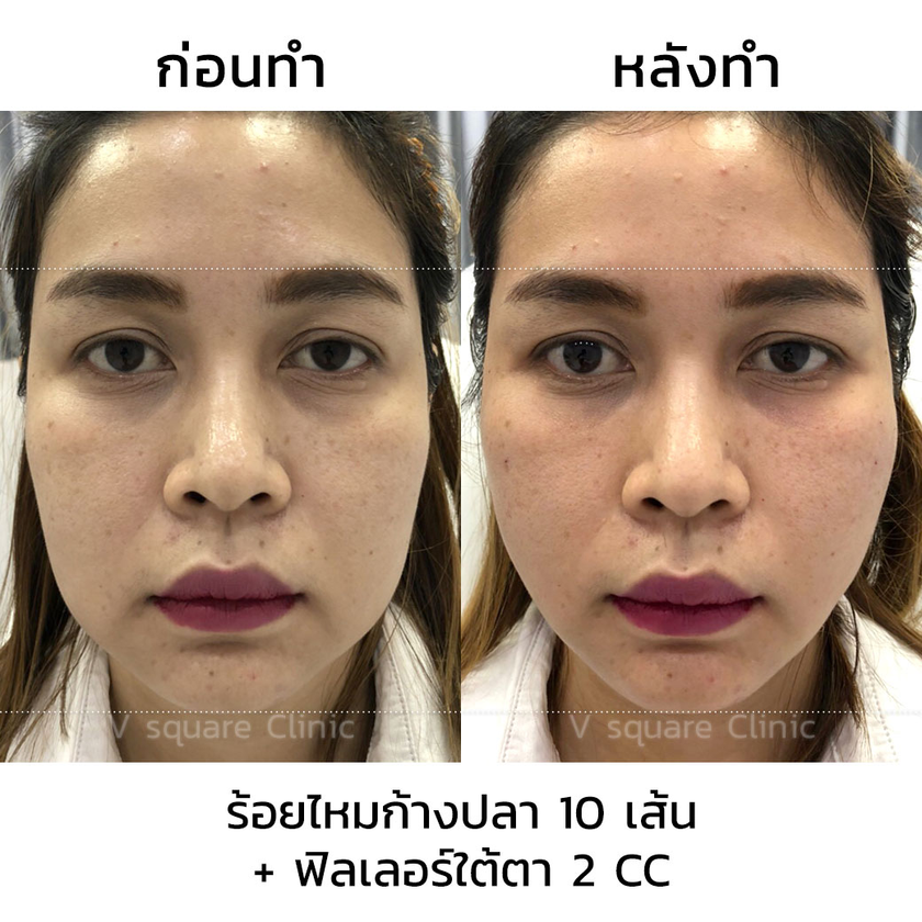 รีวิวร้อยไหมก้างปลา