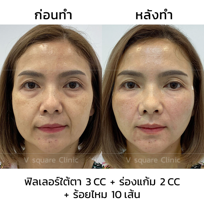 รีวิวร้อยไหมก้างปลา (5)