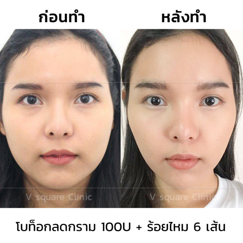 รีวิวร้อยไหมก้างปลา