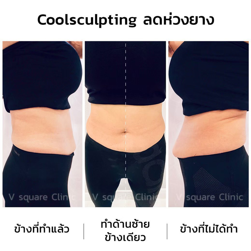 รีวิวสลายไขมันด้วยความเย็น1