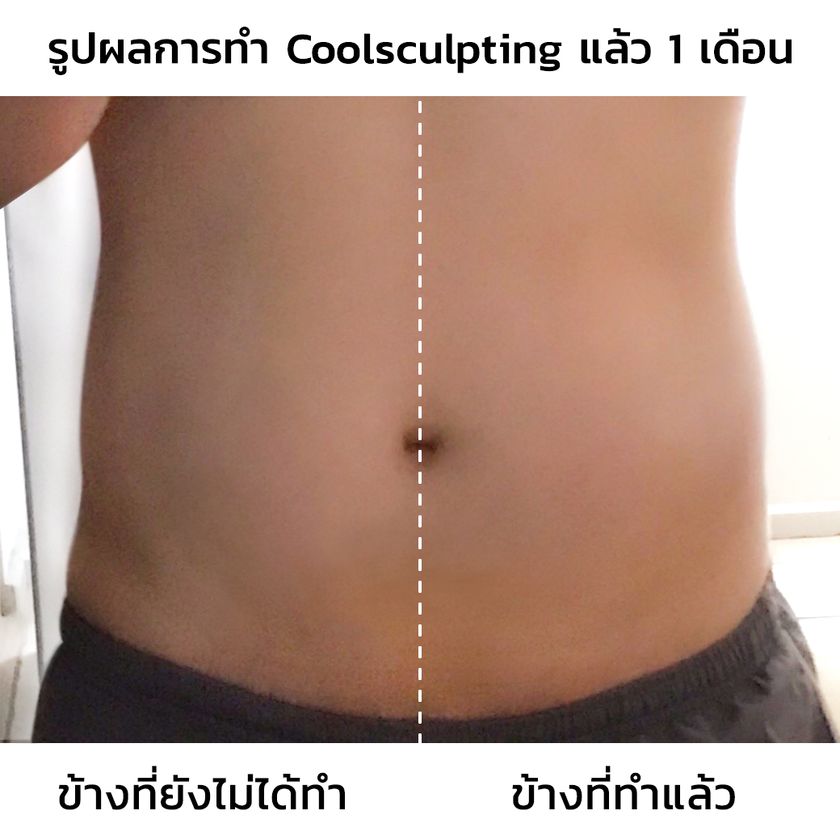 รีวิวสลายไขมันด้วยความเย็น2