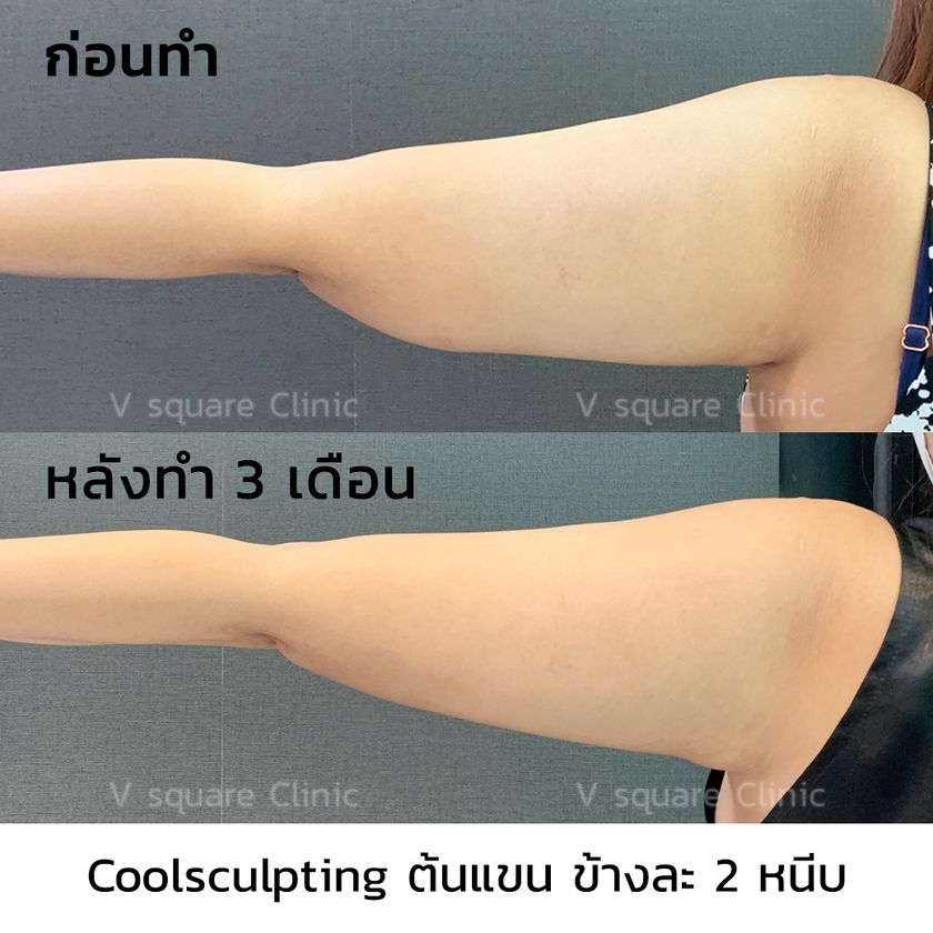 รีวิวสลายไขมันด้วยความเย็น3