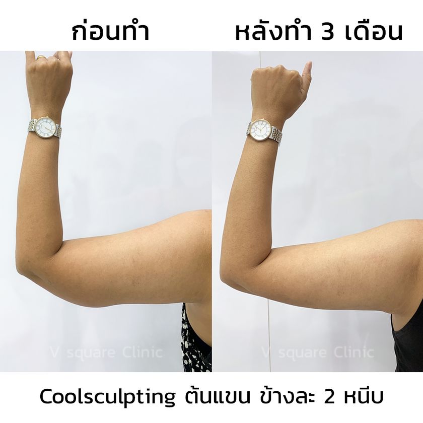 รีวิวสลายไขมันด้วยความเย็น4