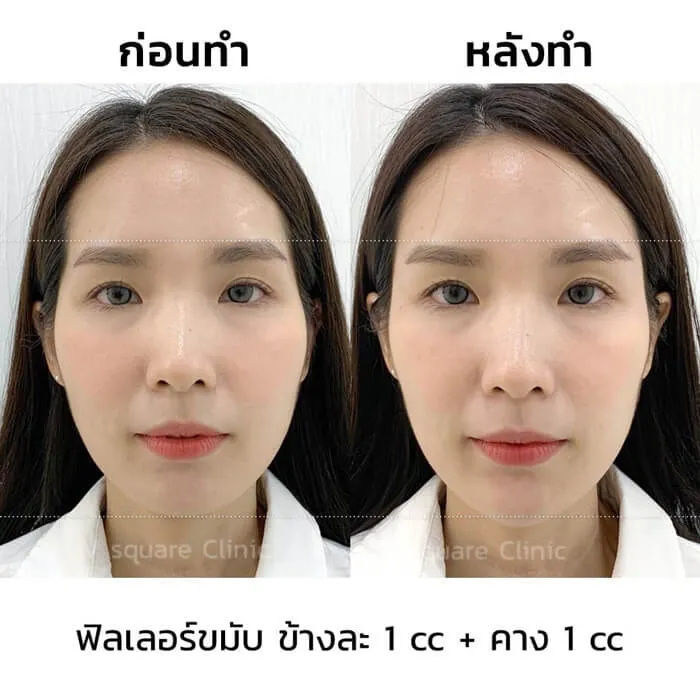 รีวิวฟิลเลอร์ขมับ(1)_1