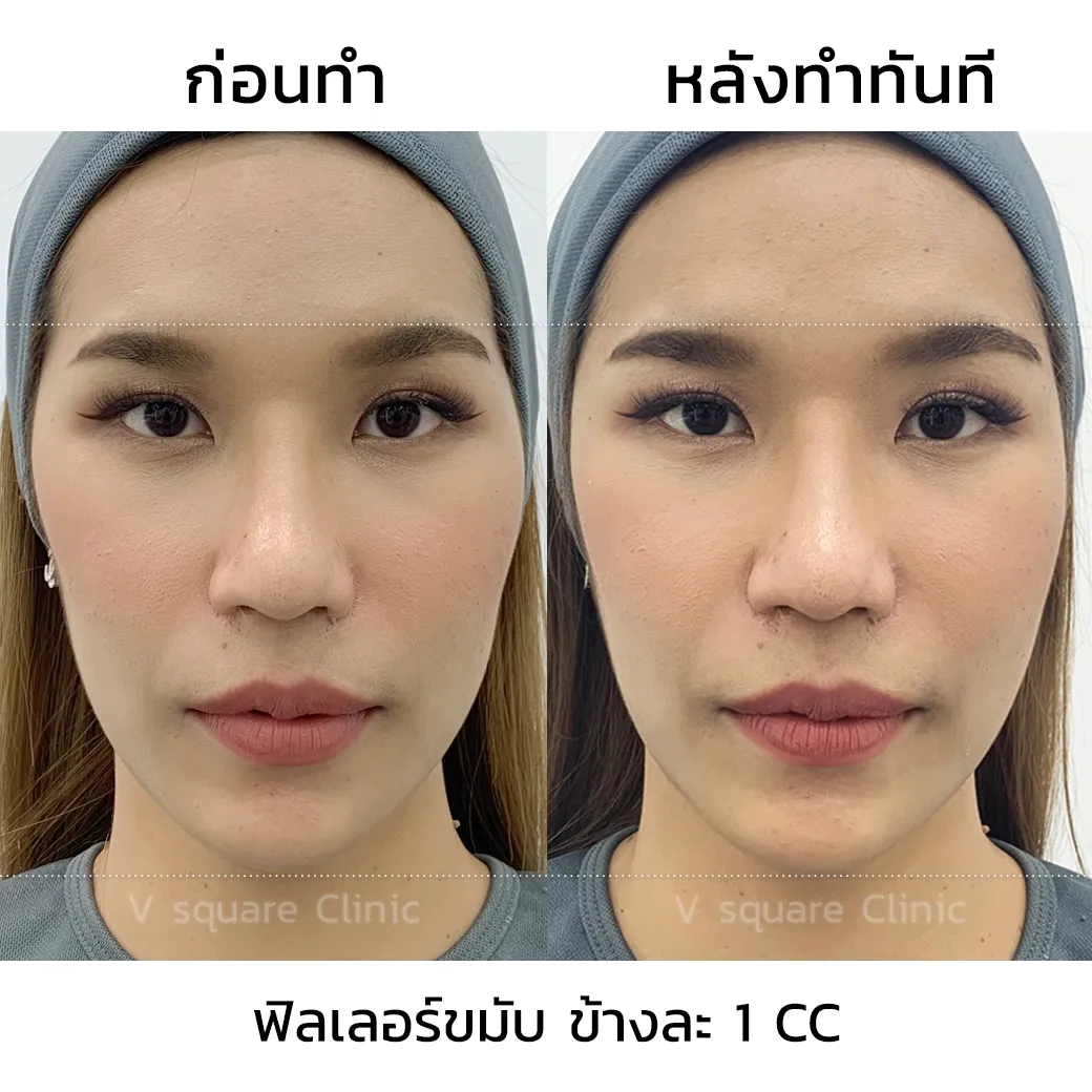 รีวิวฟิลเลอร์ขมับ(2)