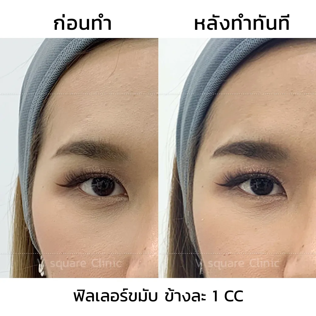 รีวิวฟิลเลอร์ขมับ(3)
