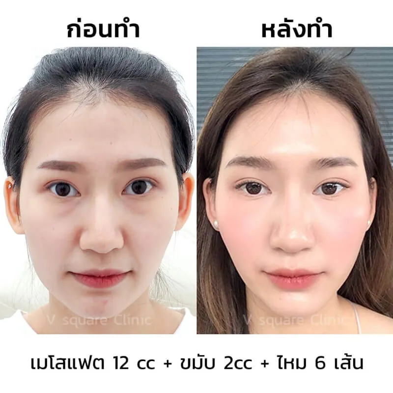 รีวิวฟิลเลอร์ขมับ_1