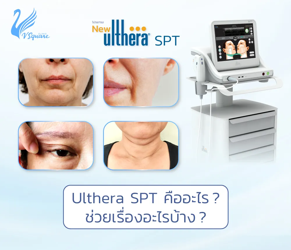 Ulthera-SPT1000x860