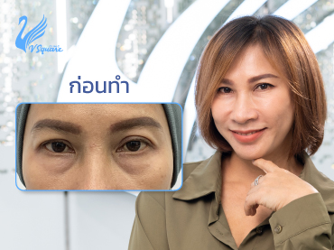 ใต้ตาคล้ำ เบ้าตาลึก ร่องตาลึก