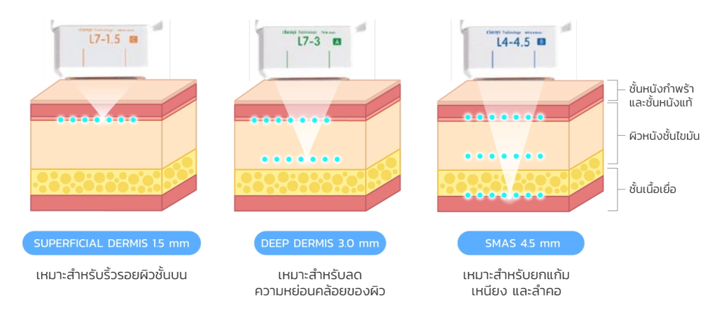 Hifu tips