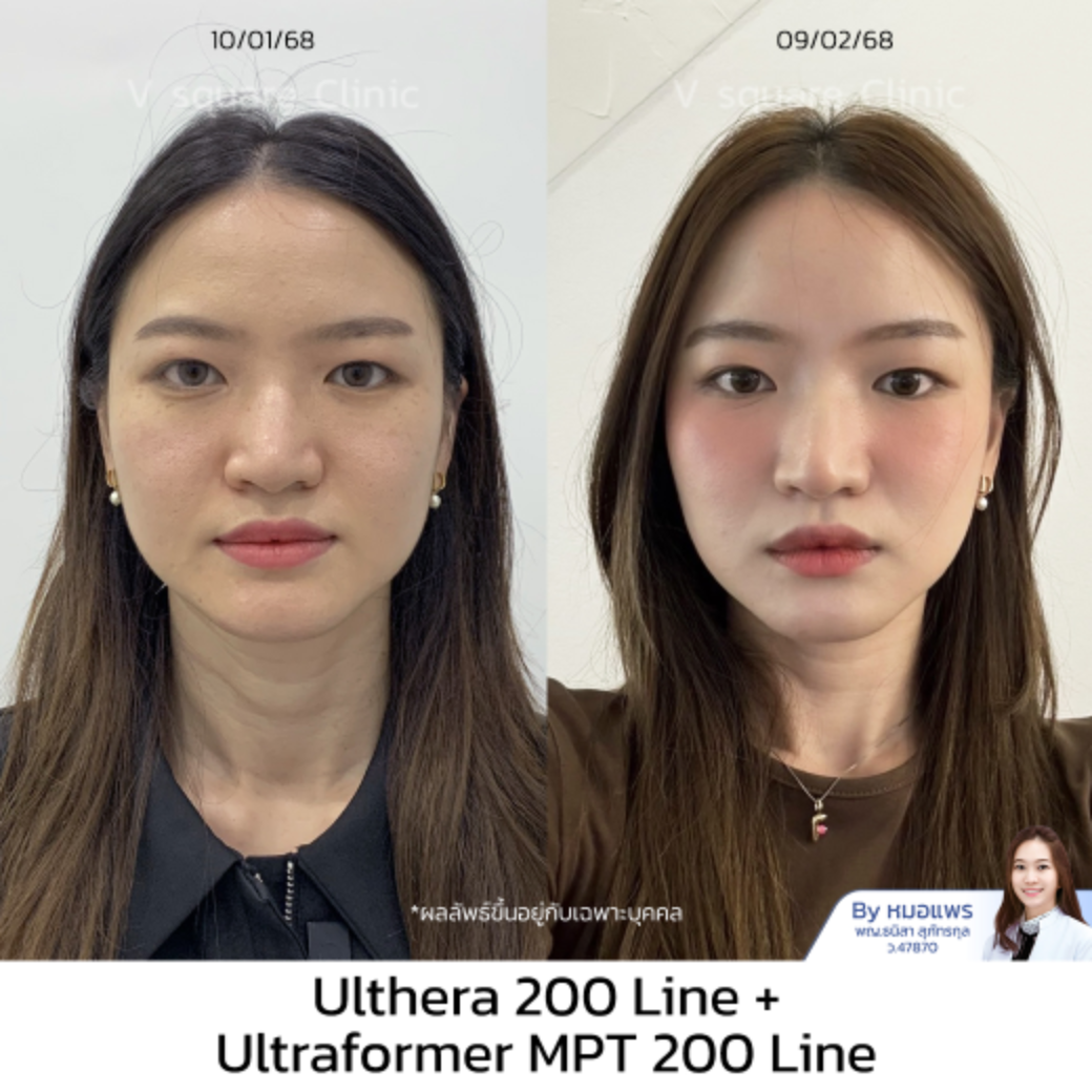 Hifu รีวิว