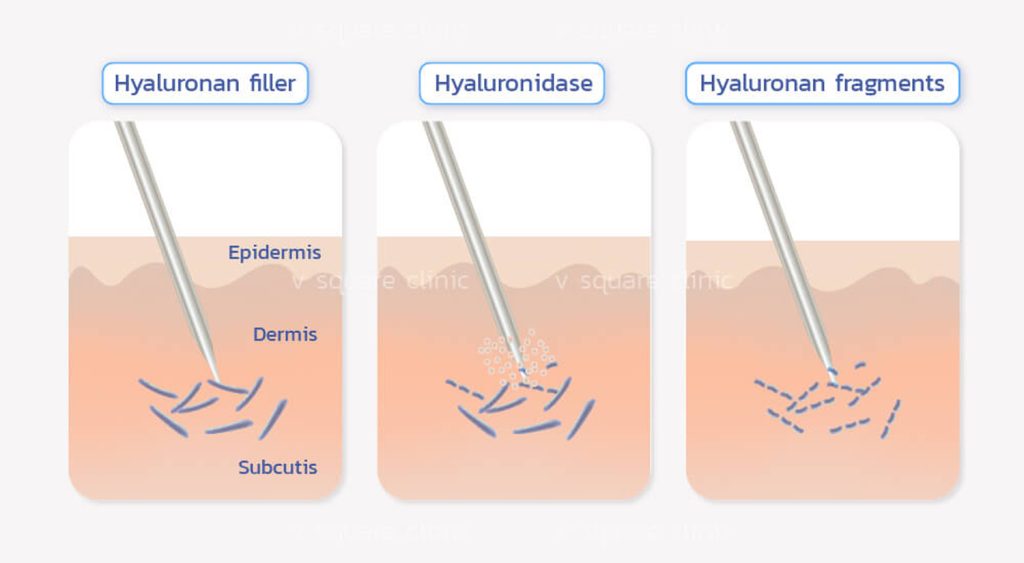 Hyaluronidase