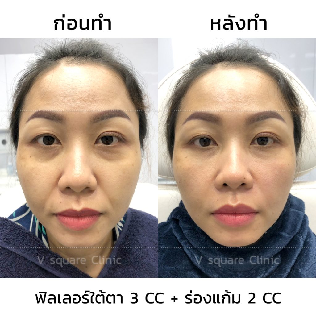 รีวิวฟิลเลอร์ใต้ตา