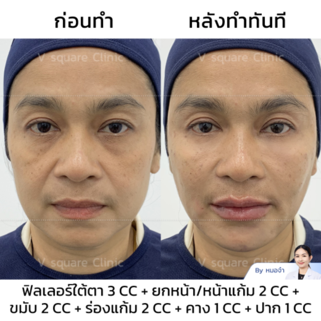 รีวิวฟิลเลอร์ใต้ตา_คุณกบ_แบบเบสๆ