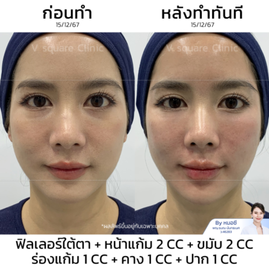 รีวิวฟิลเลอร์ใต้ตา_คุณกุ๊กกิ๊ก