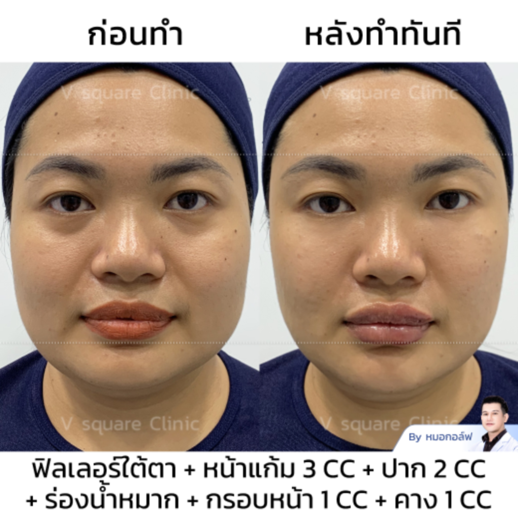 รีวิวฟิลเลอร์ใต้ตา_คุณทราย