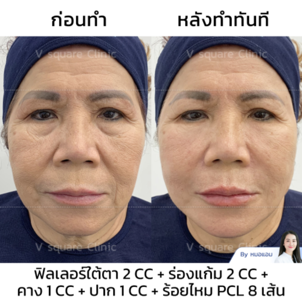 รีวิวฟิลเลอร์ใต้ตา_คุณหมวย
