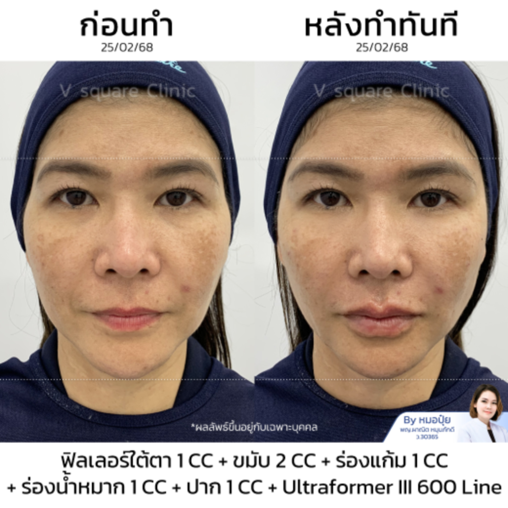 รีวิวฟิลเลอร์ใต้ตา_คุณหมวย(1)
