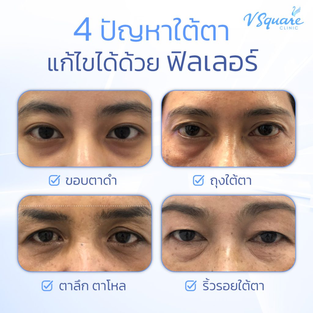 เติมฟิลเลอร์แก้ปัญหาใต้ตา