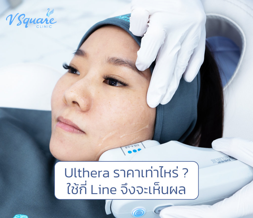 Ulthera ราคา